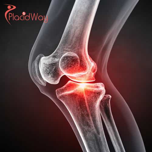 Knee Arthrosis Stem Cell Therapy in Japan: A Comprehensive Guide